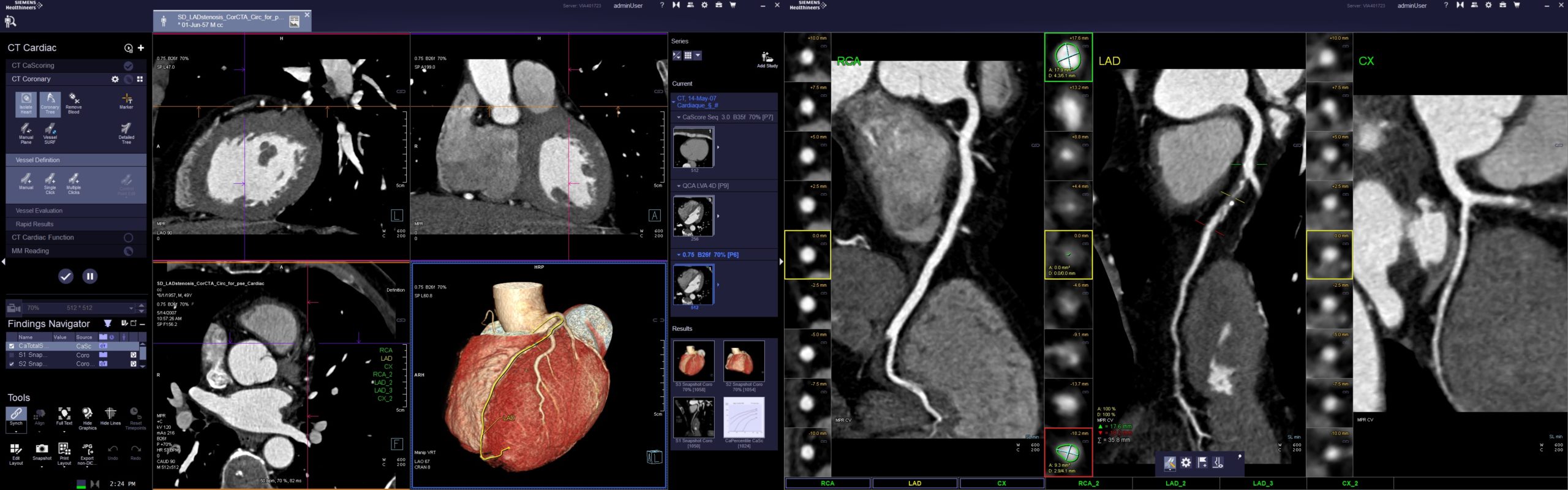tomografie computerizată pentru prostatită tratamentul prostatitei cu cordyceps